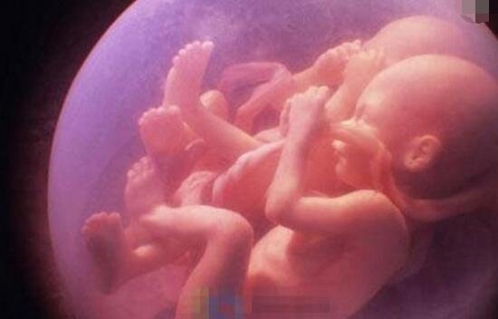 揭秘印度男子肚内36年的人形胎儿谜团 孪生兄弟胎内胎
