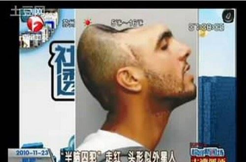 脑袋只有一半的半脑哥 脑袋被车祸削掉一半依旧正常存活