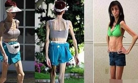 世界最丑骷髅女孩丽兹·维拉斯奎兹 每天吃60顿饭却零脂肪