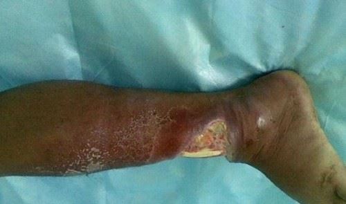 原矛头蝮龟壳花蛇 0.12毫克毒液让人溃烂致死咬伤图片