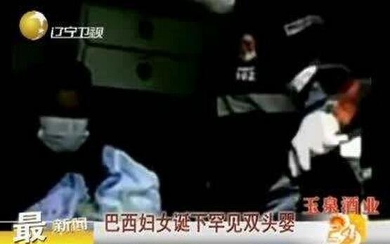 巴西双头婴儿意外诞生 两个头颅共用一个身体依旧存活