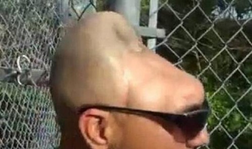 脑袋只有一半的半脑哥 脑袋被车祸削掉一半依旧正常存活