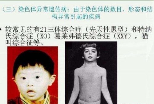 猫叫综合症的临床表现是什么?猫叫综合症能活多久