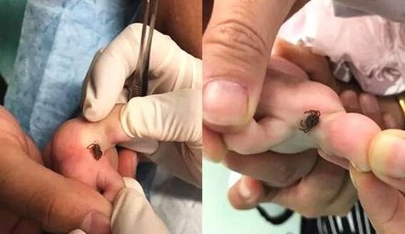 蜱虫咬人后有什么症状 轻者会大面积红肿(严重会持续高烧致死)