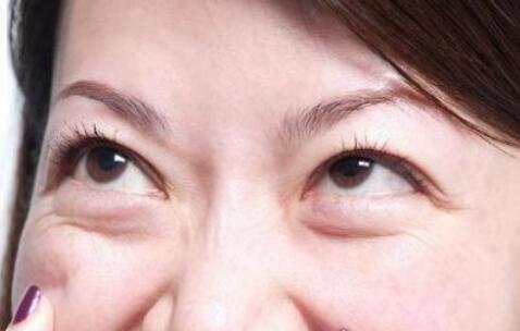 大蒜去眼袋方法 与精油和温水一起敷在眼袋处(30天就能去掉)