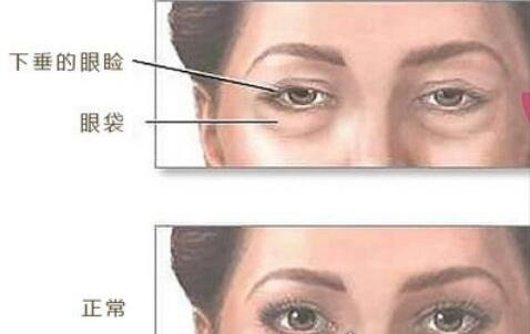 大蒜去眼袋方法 与精油和温水一起敷在眼袋处(30天就能去掉)