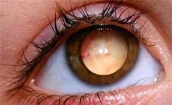 人类5种罕见的瞳孔 原来这个世界真的有白眼(视网膜癌)