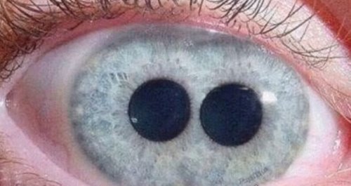 人类5种罕见的瞳孔 有些是疾病的象征（可致人死亡）