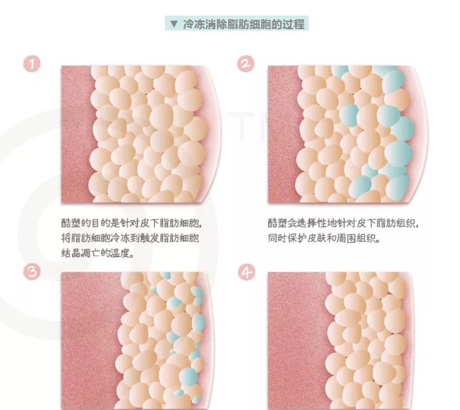 西安艾薇美医疗美容医院酷塑冷冻溶脂高婷婷主任好吗