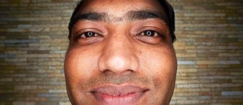 世界上牙齿最多的人 印度一小伙长出37颗牙(比常人多出5颗)