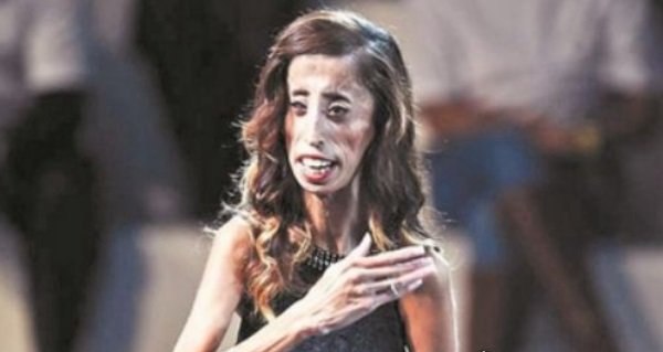女人最奇葩的世界纪录 最胖时不超27.3公斤(又称骷髅女孩)