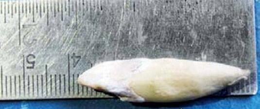 世界上牙齿最长的人 长17厘米的巨牙是假新闻(最长3.67cm)