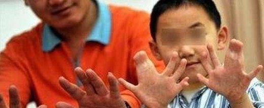 世界上手指最多的人 印度男孩手指脚趾共有34个(与遗传有关)