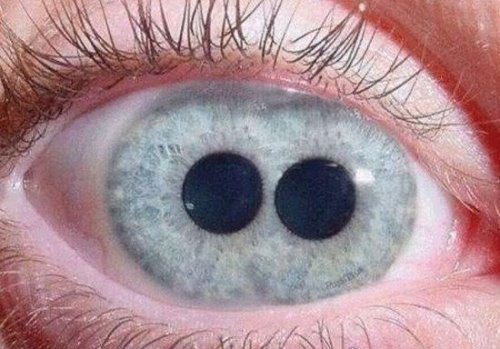 人类5种罕见的瞳孔 原来这个世界真的有白眼(视网膜癌)