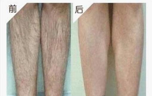 激光脱毛6年后后悔了 会破坏皮肤毛囊(激光脱毛注意事项)