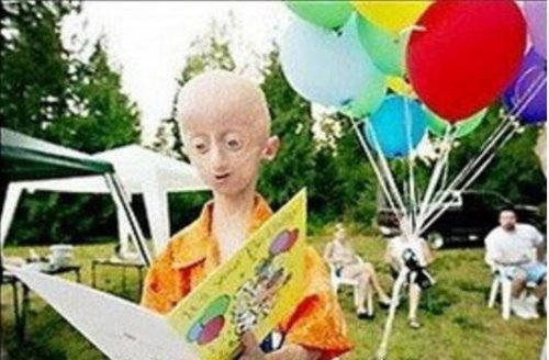 世界上最老的孩子 塞斯·库克(12岁的年纪90岁的面容)