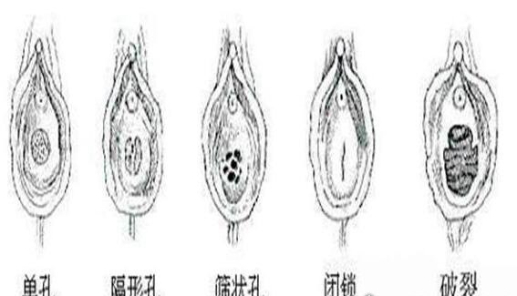女人是石女是什么意思？无子宫/无阴dao的一类女性