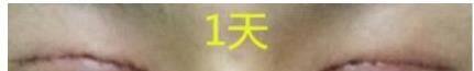 亲身经历割双眼皮手术的恢复过程