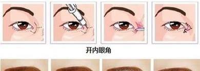 开眼角术后疤痕多久才能消失