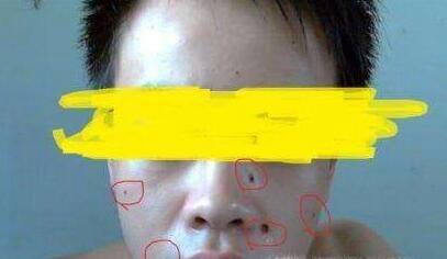 激光点痣后怎么护理