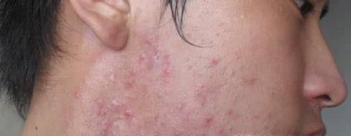 教你如何调理暗疮性皮肤
