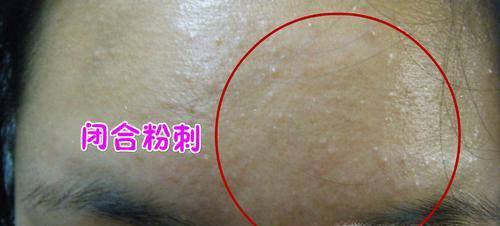 6个导致你长闭口粉刺的原因