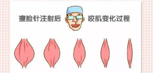 瘦脸针多少钱一针 瘦脸针能保持多久