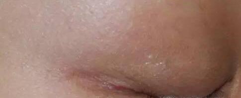 8种双眼皮整容失败症状以及修复