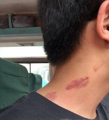 草莓印怎么消除 草莓印最快消除的方法
