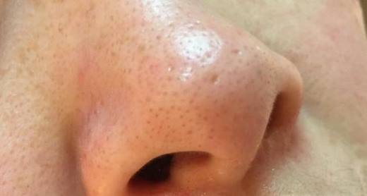 你对黑头有多少的了解呢?