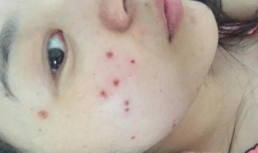 激光点痣后怎么护理