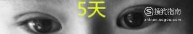 亲身经历割双眼皮手术的恢复过程