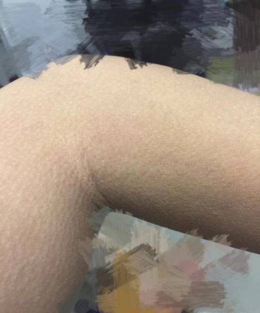 鱼鳞病的原因及护理